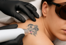 Tattoo removal: From intake to aftercare  your complete guide