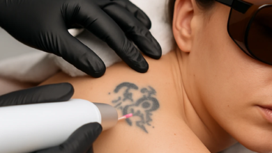 Tattoo removal: From intake to aftercare  your complete guide