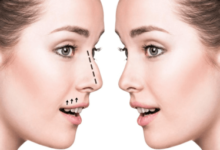 Rhinoplasty