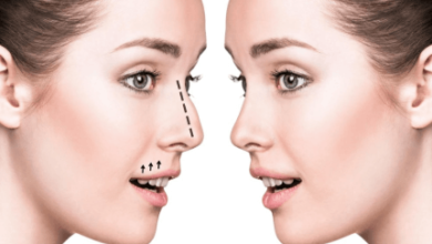Rhinoplasty