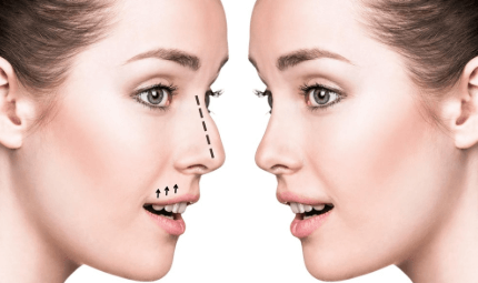 Rhinoplasty